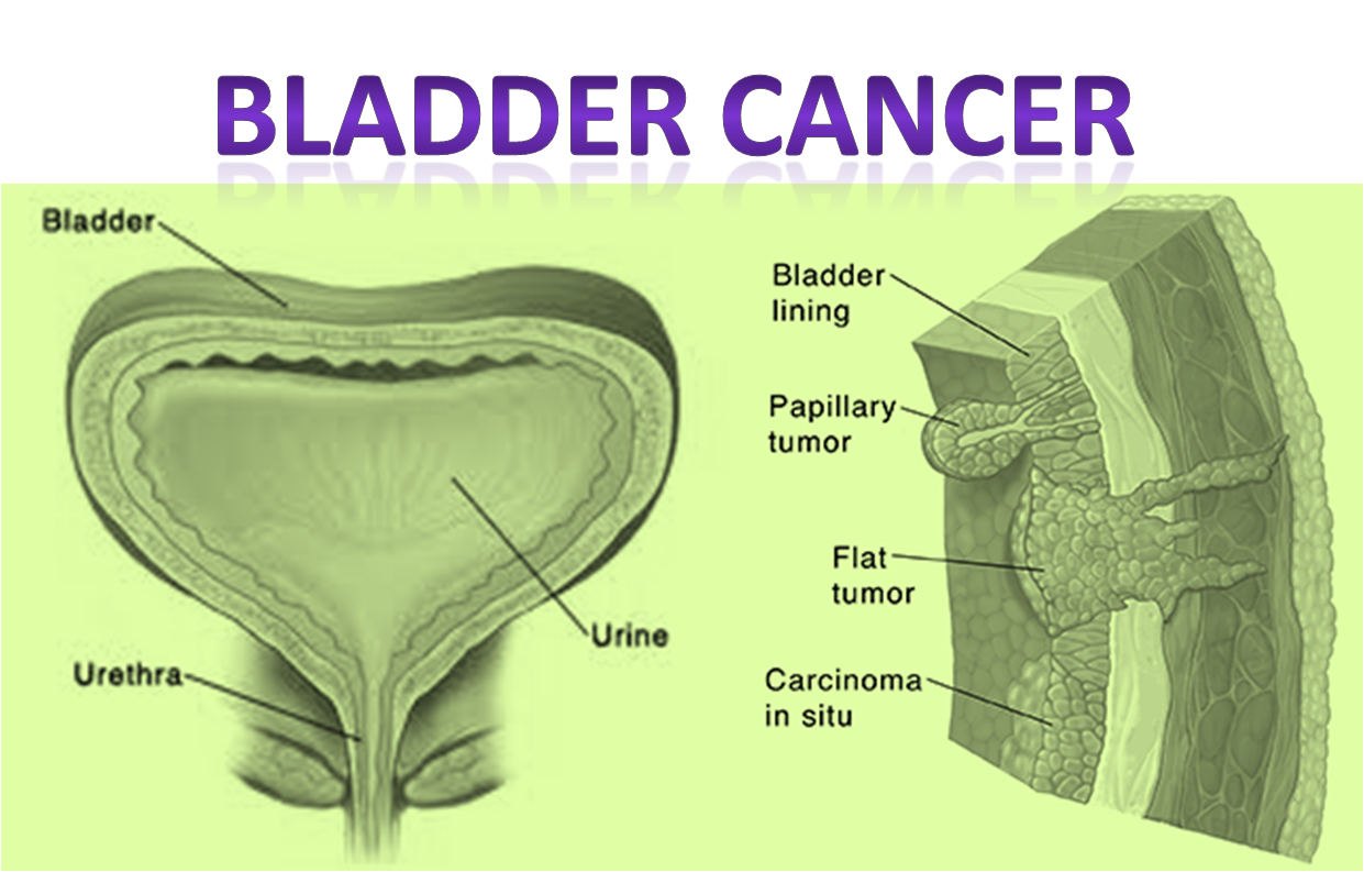 Bladder Cancer is Cause of Concern World-wide